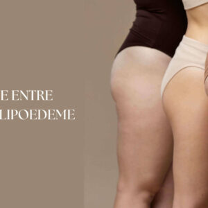 Difference-celluilite-lipoedeme