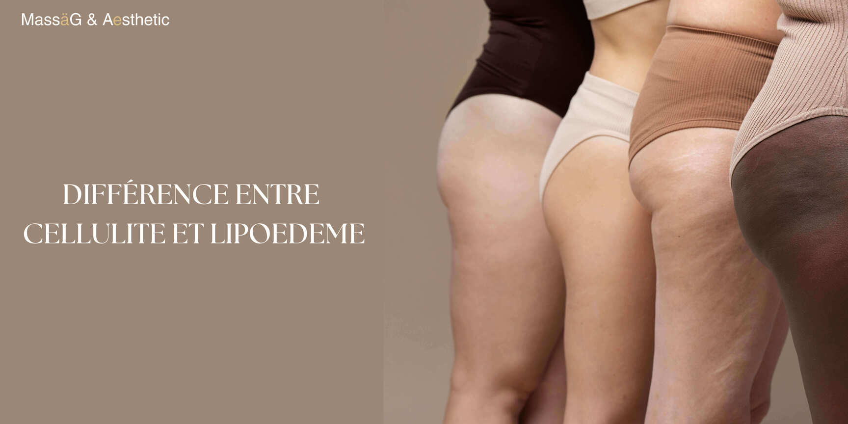 Cellulite ou lipœdème ? Comment les différencier et que faire ?
